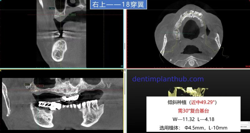 Case 1: Maxilla all - on - 6 & 36, 45, and 46.