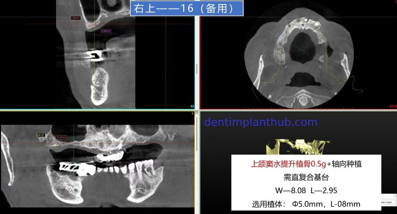 Case 1: Maxilla all - on - 6 & 36, 45, and 46.