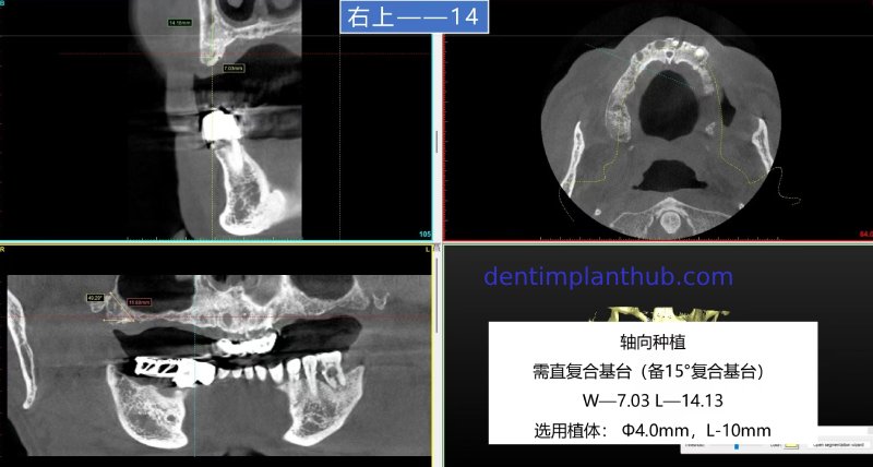 Case 1: Maxilla all - on - 6 & 36, 45, and 46.