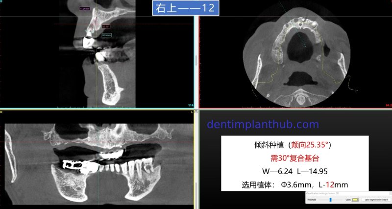 Case 1: Maxilla all - on - 6 & 36, 45, and 46.
