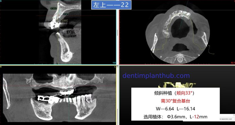 Case 1: Maxilla all - on - 6 & 36, 45, and 46.