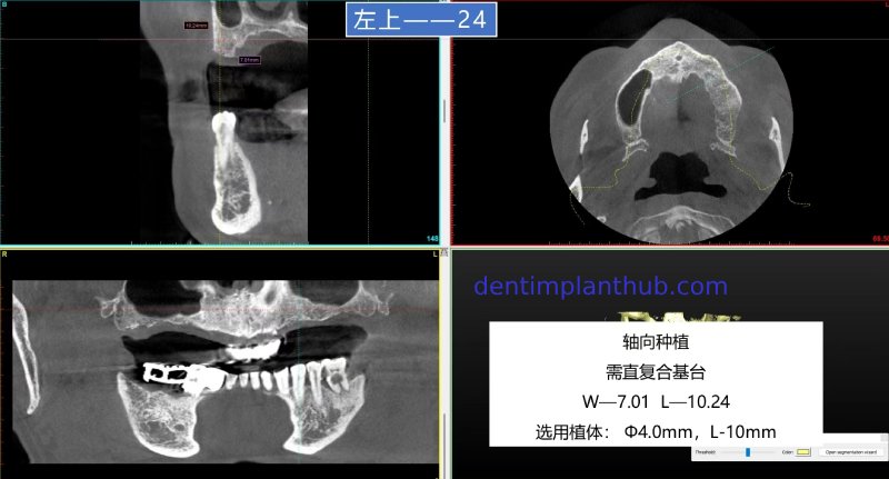 Case 1: Maxilla all - on - 6 & 36, 45, and 46.