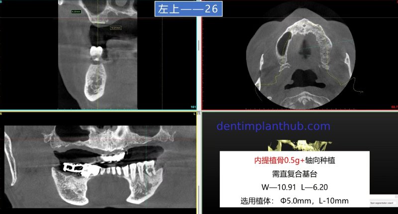 Case 1: Maxilla all - on - 6 & 36, 45, and 46.