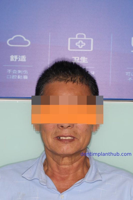 Case 1: Maxilla all - on - 6 & 36, 45, and 46.