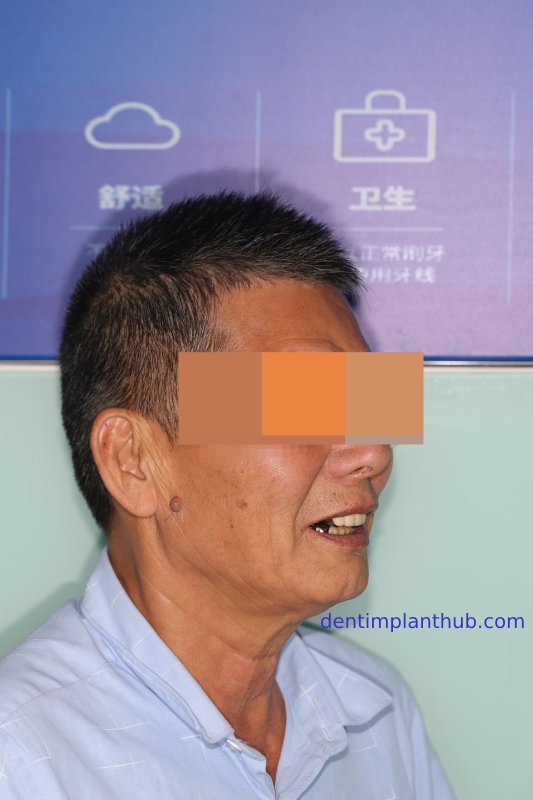 Case 1: Maxilla all - on - 6 & 36, 45, and 46.