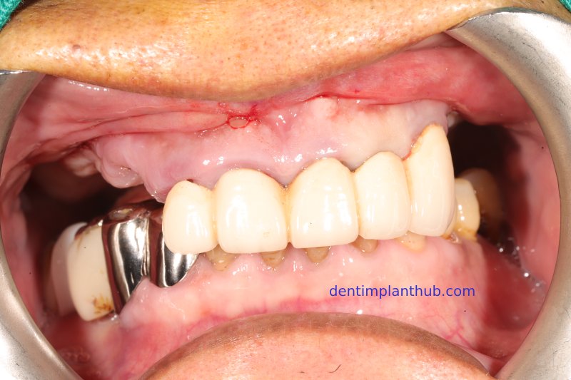 Case 1: Maxilla all - on - 6 & 36, 45, and 46.