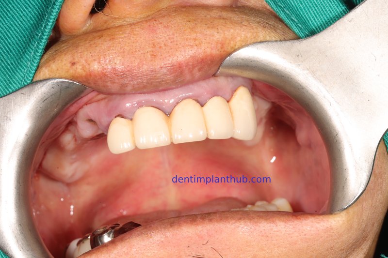 Case 1: Maxilla all - on - 6 & 36, 45, and 46.