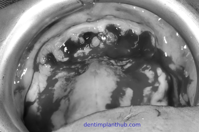 Case 1: Maxilla all - on - 6 & 36, 45, and 46.