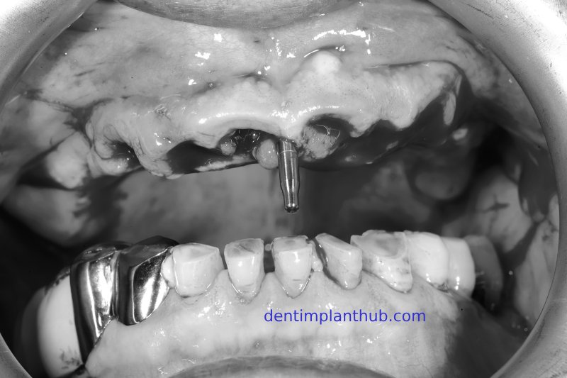 Case 1: Maxilla all - on - 6 & 36, 45, and 46.