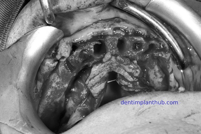 Case 1: Maxilla all - on - 6 & 36, 45, and 46.