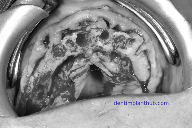 Case 1: Maxilla all - on - 6 & 36, 45, and 46.