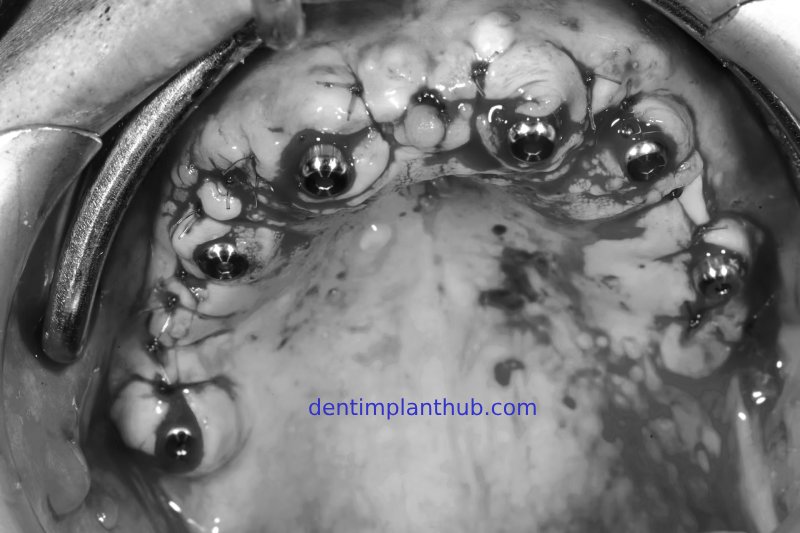 Case 1: Maxilla all - on - 6 & 36, 45, and 46.