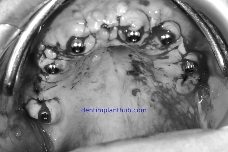 Case 1: Maxilla all - on - 6 & 36, 45, and 46.