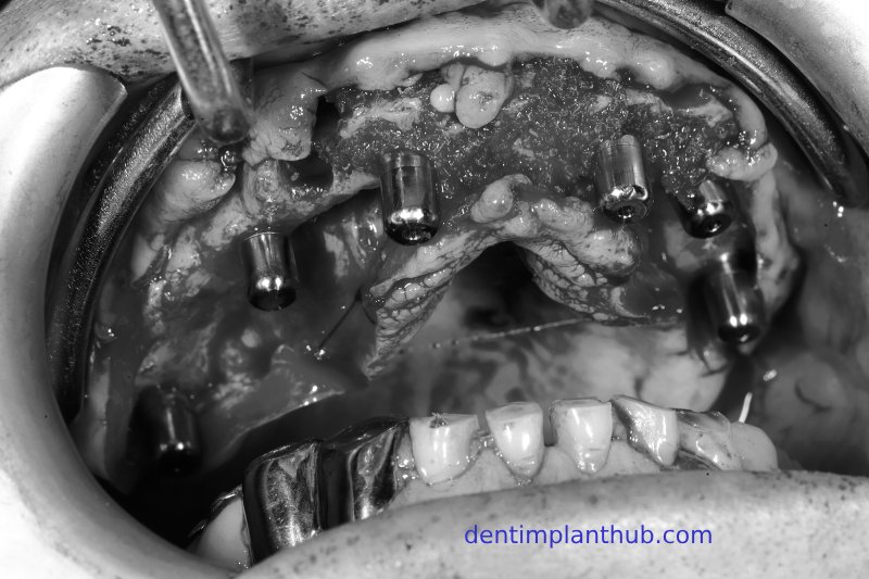 Case 1: Maxilla all - on - 6 & 36, 45, and 46.