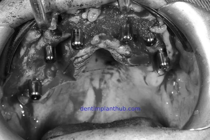 Case 1: Maxilla all - on - 6 & 36, 45, and 46.