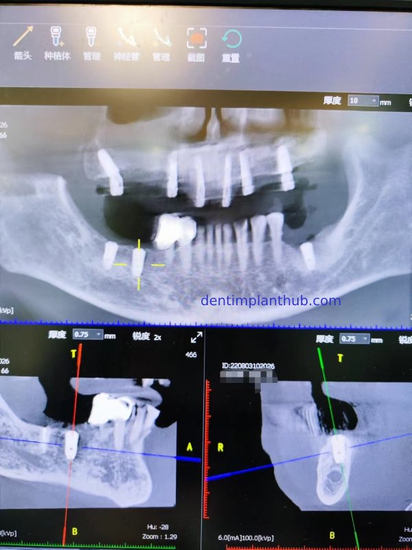 Case 1: Maxilla all - on - 6 & 36, 45, and 46.