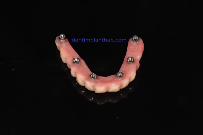 Case 1: Maxilla all - on - 6 & 36, 45, and 46.