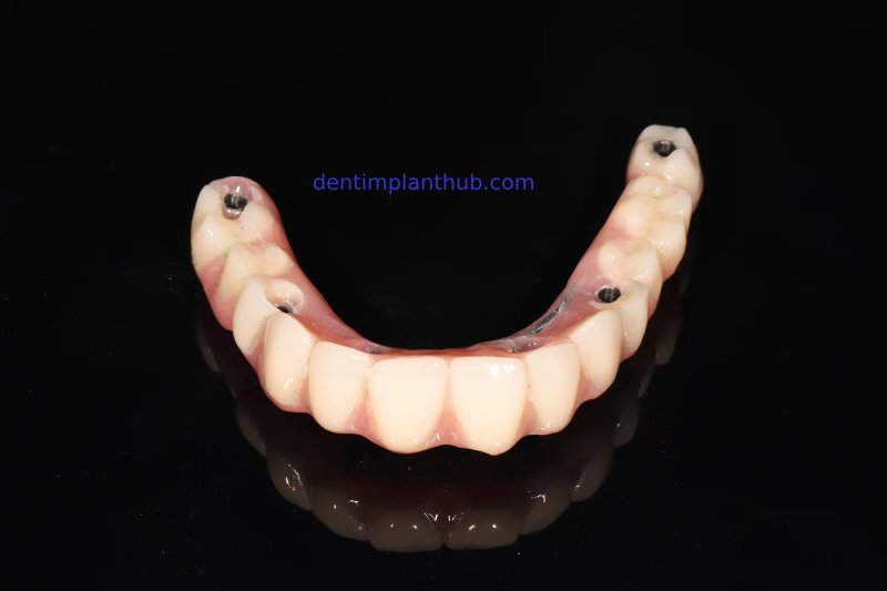 Case 1: Maxilla all - on - 6 & 36, 45, and 46.