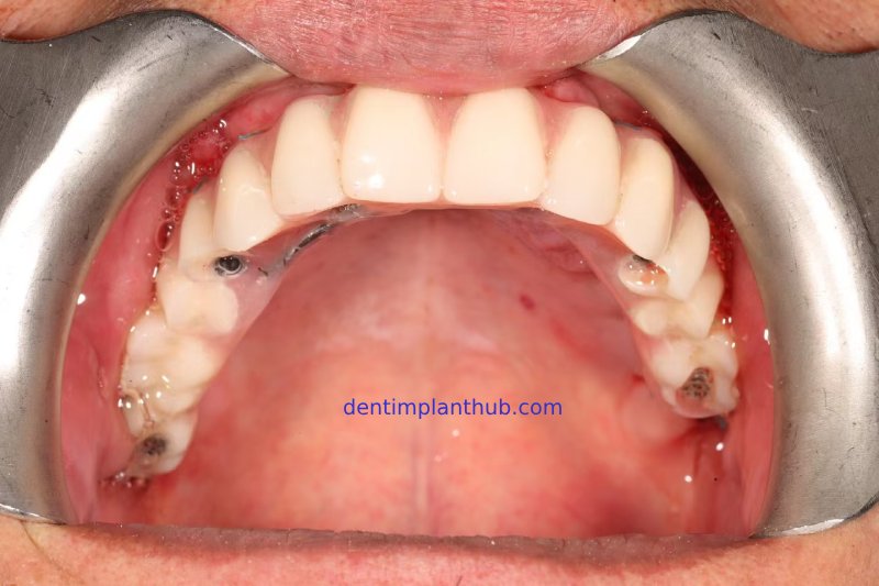 Case 1: Maxilla all - on - 6 & 36, 45, and 46.