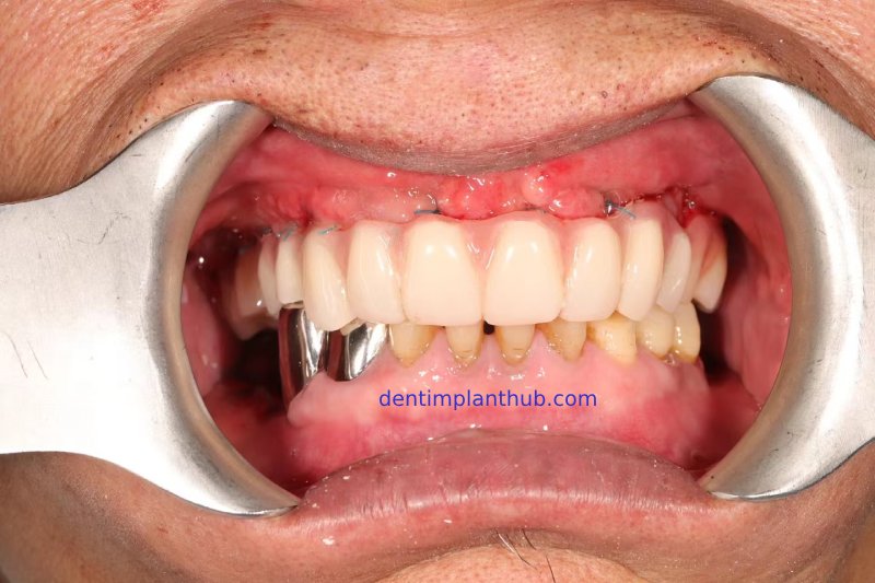 Case 1: Maxilla all - on - 6 & 36, 45, and 46.