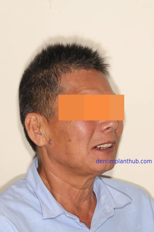 Case 1: Maxilla all - on - 6 & 36, 45, and 46.