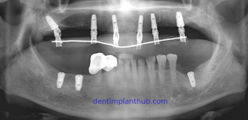 Case 1: Maxilla all - on - 6 & 36, 45, and 46.