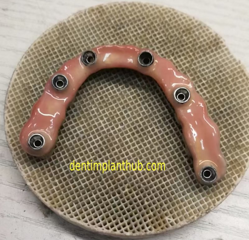 Case 1: Maxilla all - on - 6 & 36, 45, and 46.