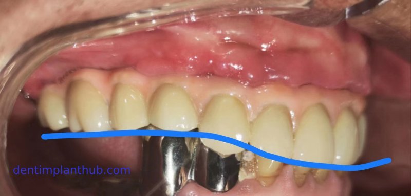 Case 1: Maxilla all - on - 6 & 36, 45, and 46.