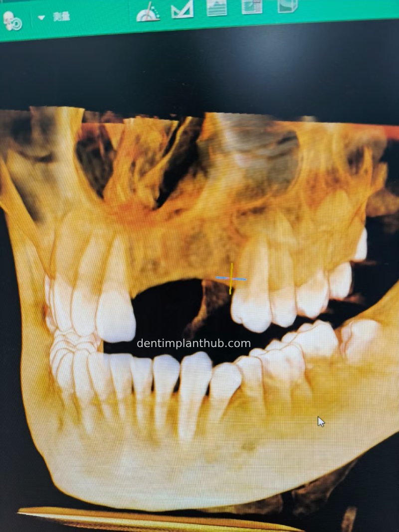 Case 2: 21~23 bone split implantation of two implants