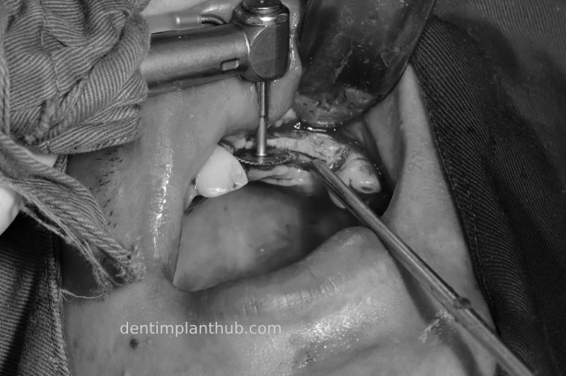 Case 2: 21~23 bone split implantation of two implants