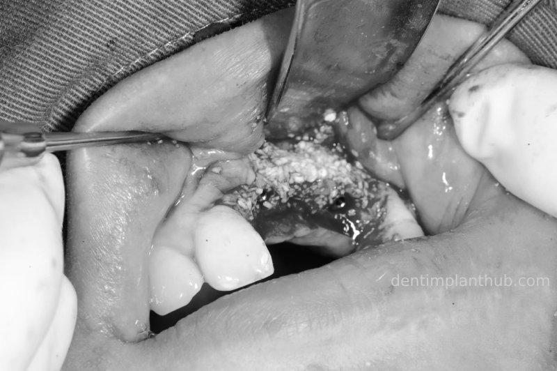 Case 2: 21~23 bone split implantation of two implants