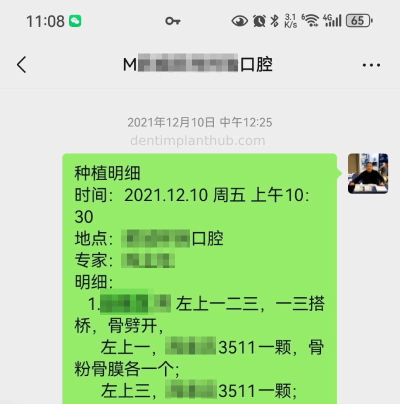 Case 2: 21~23 bone split implantation of two implants