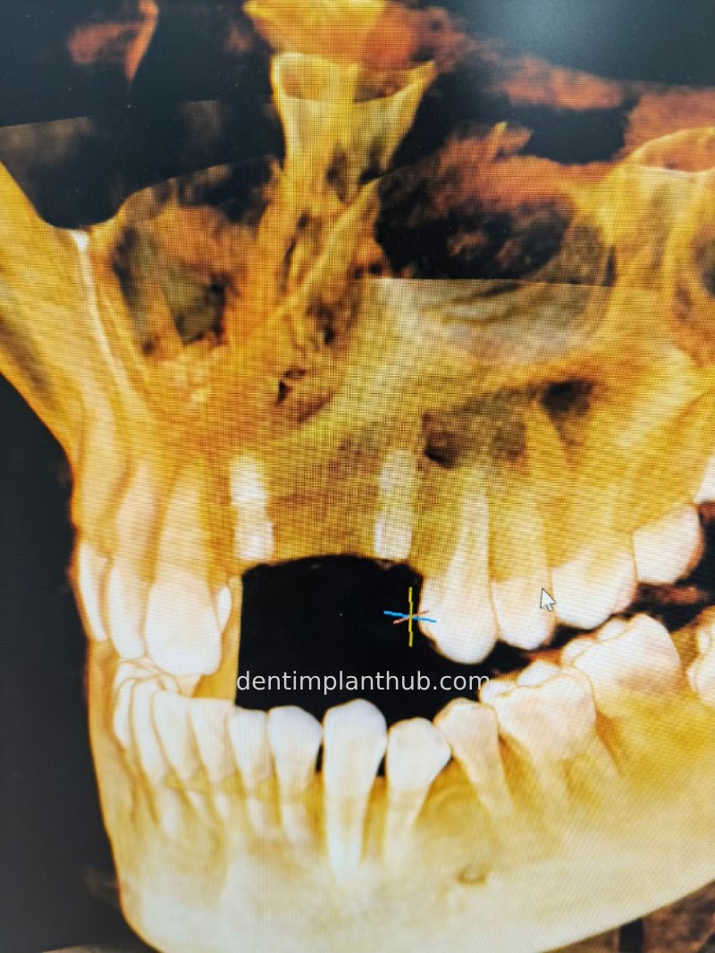Case 2: 21~23 bone split implantation of two implants