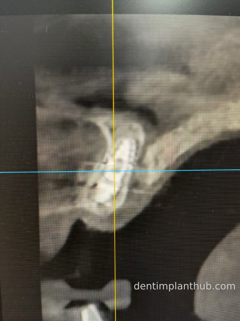 Case 2: 21~23 bone split implantation of two implants