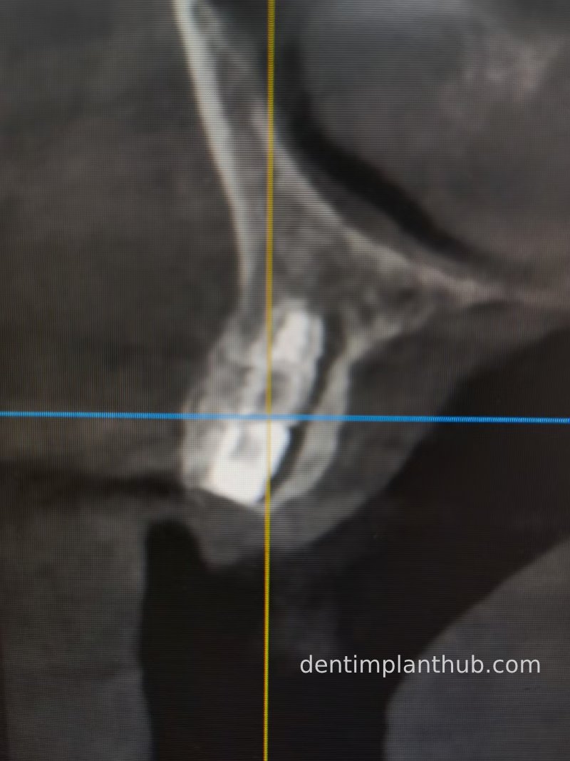 Case 2: 21~23 bone split implantation of two implants