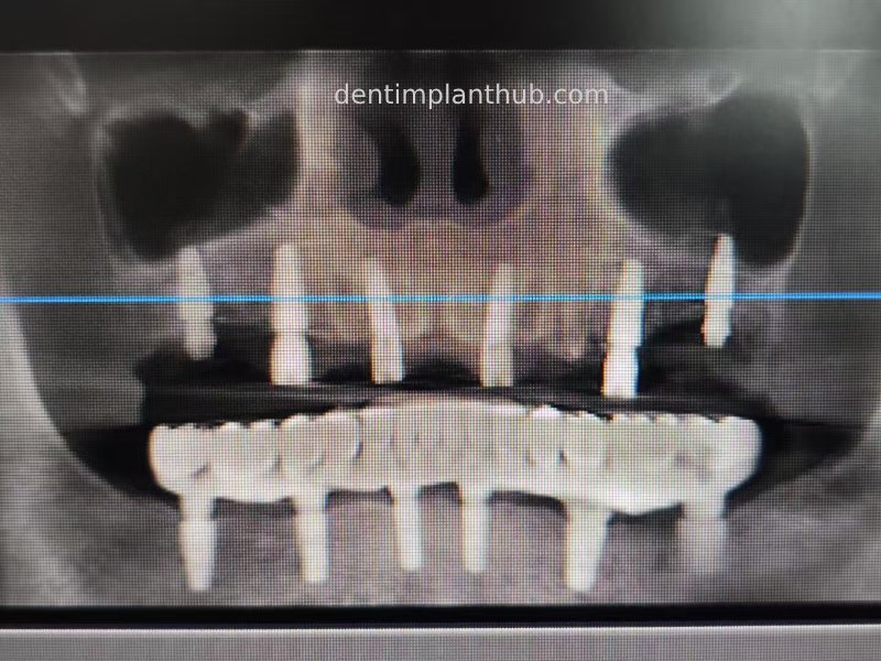 Case 3: Full mouth all-on-6 in a patient with severe periodontal disease