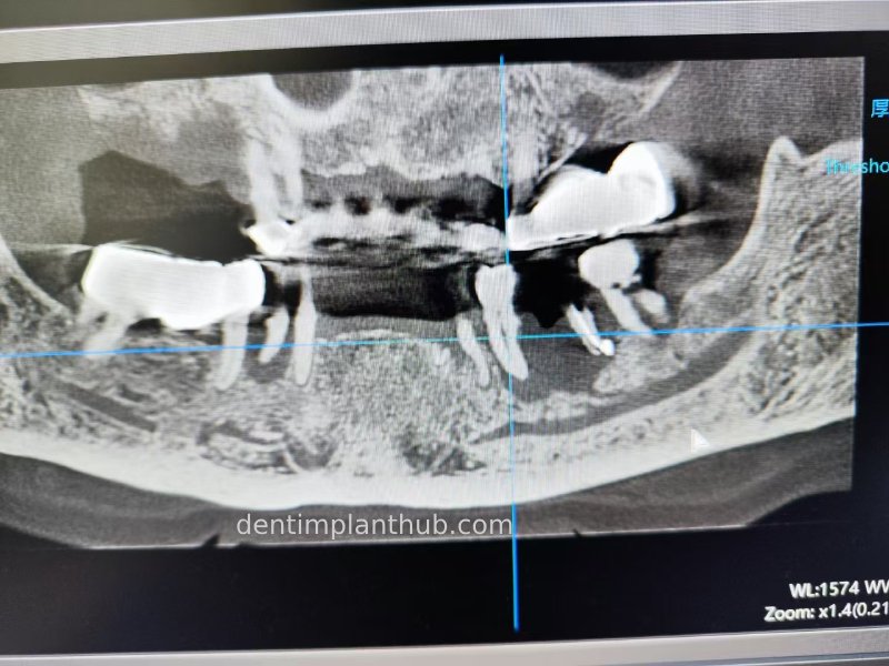 Case 3: Full mouth all-on-6 in a patient with severe periodontal disease