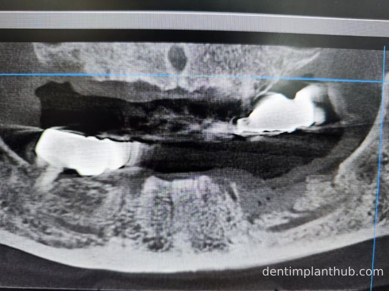 Case 3: Full mouth all-on-6 in a patient with severe periodontal disease