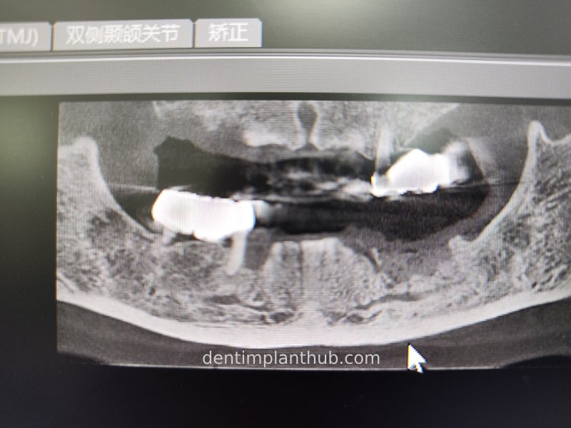 Case 3: Full mouth all-on-6 in a patient with severe periodontal disease