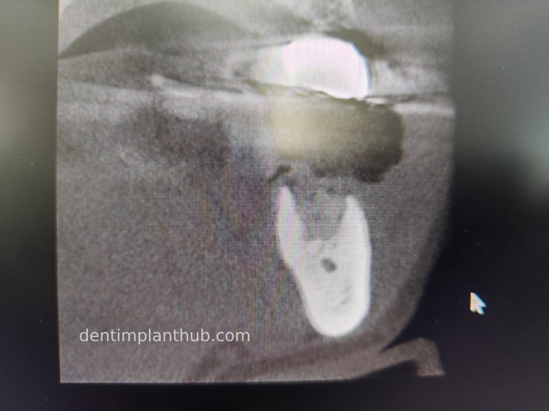 Case 3: Full mouth all-on-6 in a patient with severe periodontal disease