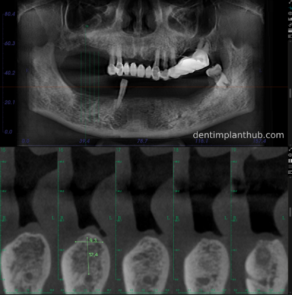 Case 3: Full mouth all-on-6 in a patient with severe periodontal disease