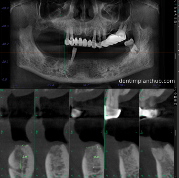 Case 3: Full mouth all-on-6 in a patient with severe periodontal disease