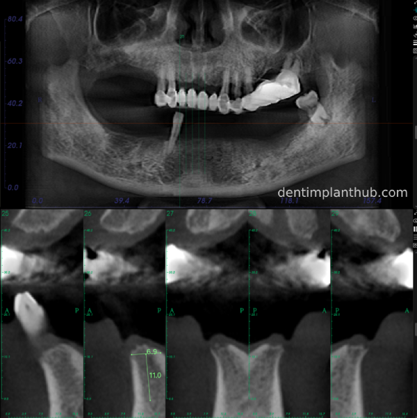 Case 3: Full mouth all-on-6 in a patient with severe periodontal disease