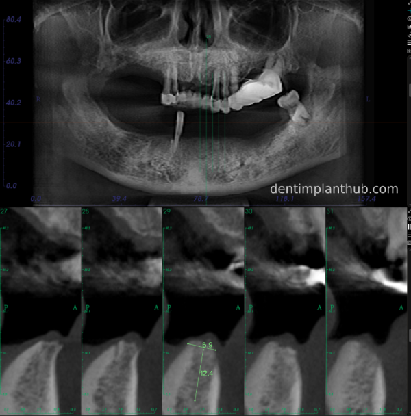 Case 3: Full mouth all-on-6 in a patient with severe periodontal disease