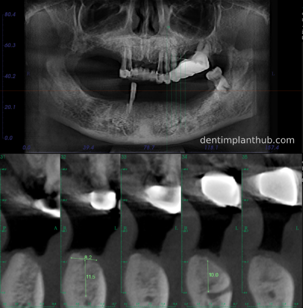 Case 3: Full mouth all-on-6 in a patient with severe periodontal disease