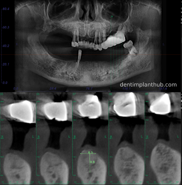 Case 3: Full mouth all-on-6 in a patient with severe periodontal disease