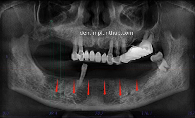 Case 3: Full mouth all-on-6 in a patient with severe periodontal disease