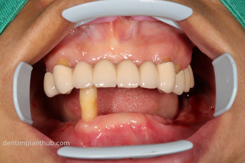 Case 3: Full mouth all-on-6 in a patient with severe periodontal disease