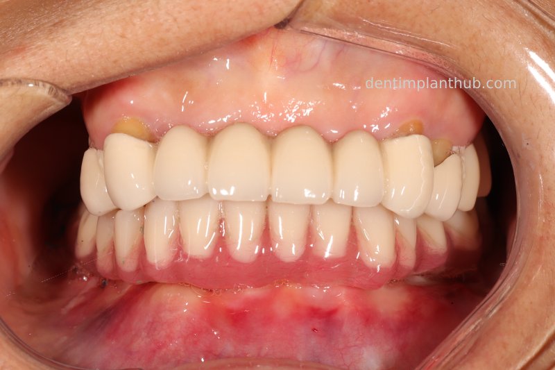 Case 3: Full mouth all-on-6 in a patient with severe periodontal disease