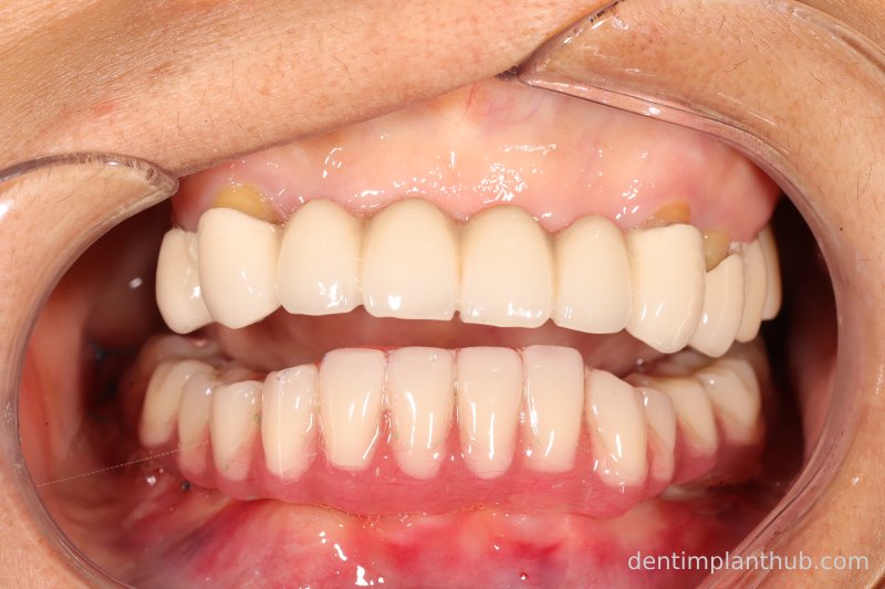 Case 3: Full mouth all-on-6 in a patient with severe periodontal disease